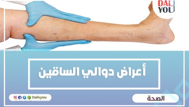 أعراض دوالي الساقين