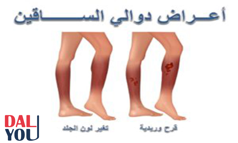 أعراض دوالي الساقين أسباب دوالي الساقين عند الحامل